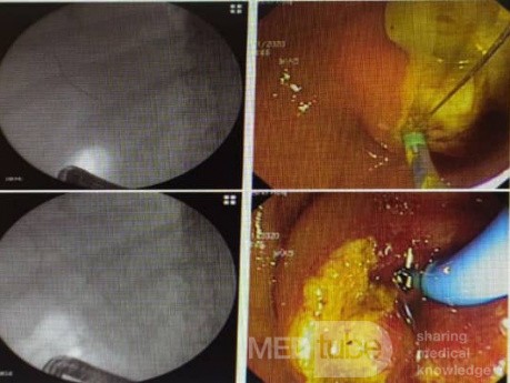 Liver Hydatid Cyst Profection to CBD and Cholangitis and Extraction of Doughter Cyst with ERCP
