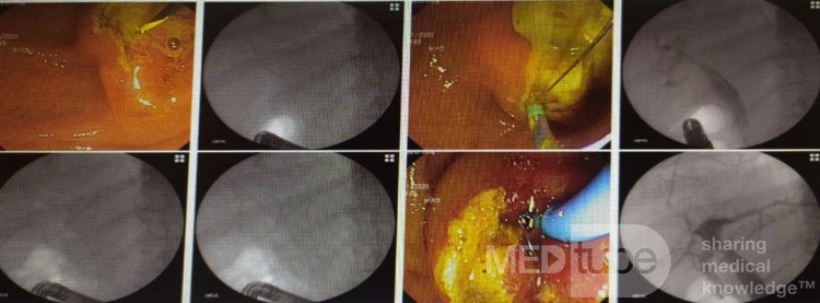 Liver Hydatid Cyst Profection to CBD and Cholangitis and Extraction of Doughter Cyst with ERCP