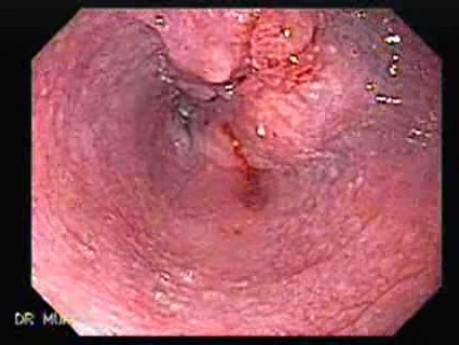 Esophageal Squamous Cell Carcinoma - Presence of the Tumor Between the Middle Third of the Esophagus and the Lower One