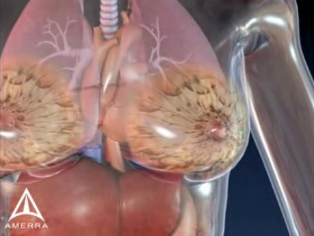 Breast cancer - 3D Medical Animation