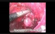 Endoscopic Fibroadenoma Excision