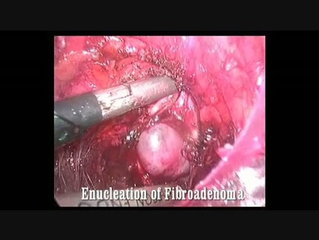Endoscopic Fibroadenoma Excision