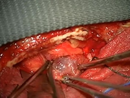 Intraorbital Tumor