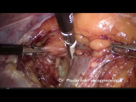 Endometrial Carcinoma Surgery