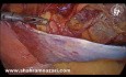 The Case of Huge Lipoma of the Spermatic Cord