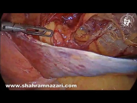The Case of Huge Lipoma of the Spermatic Cord