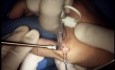 Surgical Repair of Ulnar Collateral Ligament of Thumb