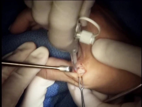 Surgical Repair of Ulnar Collateral Ligament of Thumb