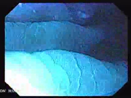 Gastric Folds - Chromoendoscopy (2 of 8)