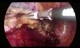 Laparoscopic Extended Left Hemicolectomy (Deloyers Procedure)