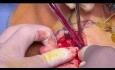 TMJ Intracapsular Condyle Fracture ORIF