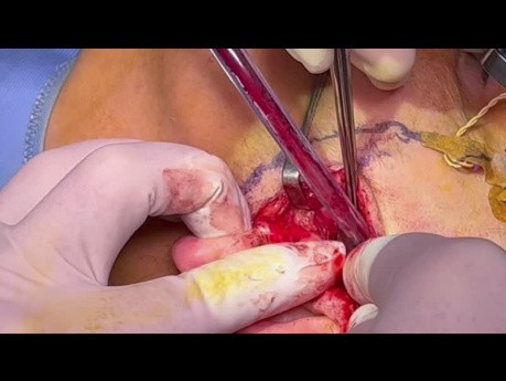 TMJ Intracapsular Condyle Fracture ORIF