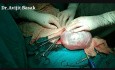 Big Ovarian Cyst Surgery