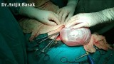 Ooforoplastia por video (cisto dermoide) / Video oophoroplasty (dermoid  cyst) 