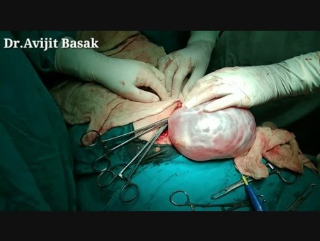Big Ovarian Cyst Surgery