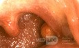 Benign Mucous Cyst Tonsil