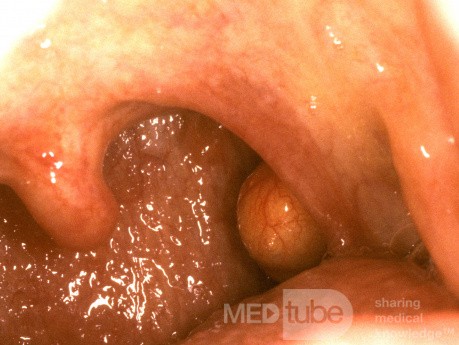 Benign Mucous Cyst Tonsil