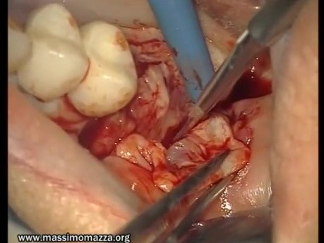 Reconstruction Of Adhesive Gingiva (1/5)