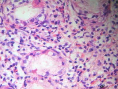 Eosinophilic Gastritis (3 of 7)