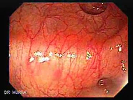 Colon Diverticulum - Endoscopy (3 of 3)