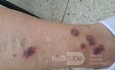 Vasculite? [1/6]