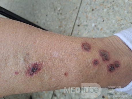 Vasculite? [1/6]