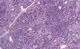 Pancreas - Adenocarcinoma