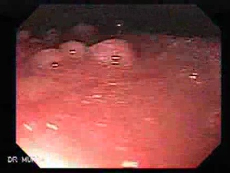 Hyperplastic Gastric Polyposis - Endoscopy (1 of 6)