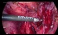 Post Hysterectomy Adnexal Mass Ureter in Mass 
