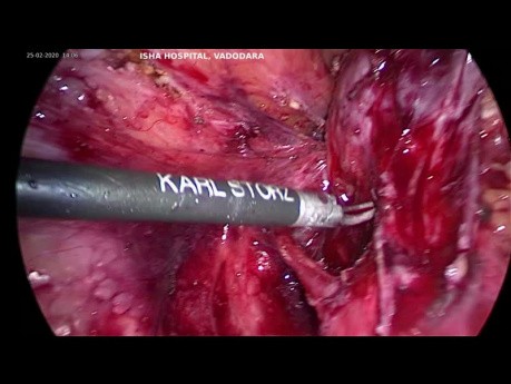 Post Hysterectomy Adnexal Mass Ureter in Mass 
