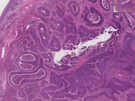 Squamous cell carcinoma - Histopathology - Cervix