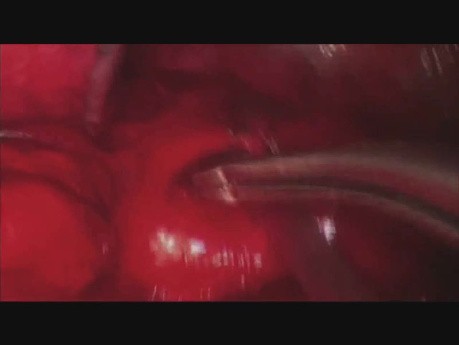 Uniportal VATS Left Lower Lobe Anatomic Basal Segmentectomy