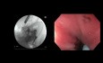 EUS-Guided Gastroenterostomy