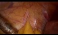 Laparoscopic Myomectomy Defect Closure with Bidirectional Quill® Barbed Suture
