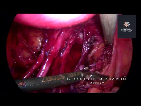 Medium Retal Artery Identification in Endometriosis Surgery
