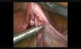 Laparoscopic Tubal Recanalisation