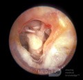Tympanosclerosis Middle Ear Mucosa