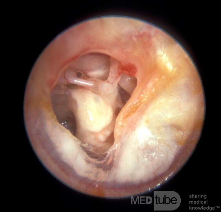 Tympanosclerosis Middle Ear Mucosa