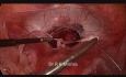 Laparoscopic Cervical Circlage