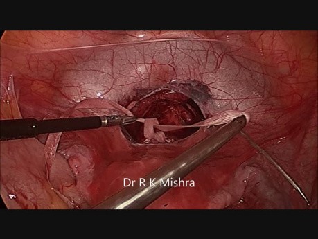 Laparoscopic Cervical Circlage