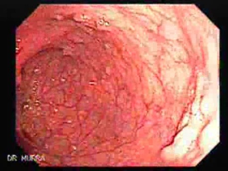 Familial Adenomatous Polyposis (20 of 36)