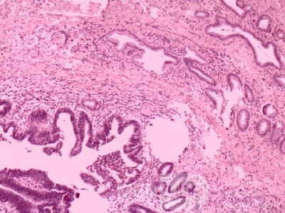 Cholangiocarcinoma that infiltrated a Periampullary Duodenal Diverticula and the head of the pancreas (16 of 20)