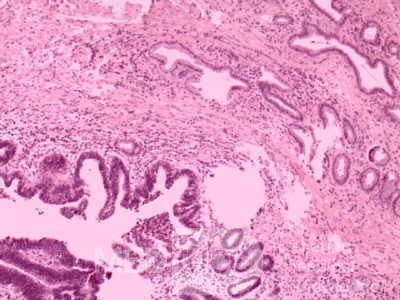 Cholangiocarcinoma that infiltrated a Periampullary Duodenal Diverticula and the head of the pancreas (16 of 20)