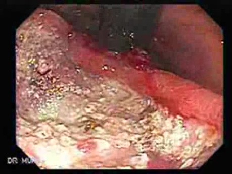 Adenocarcinoma of the Lesser Curvature (1 of 3)