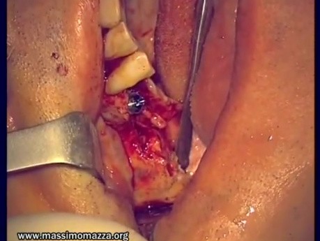 Immediate Implantation 14-18 (2/2)