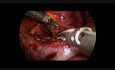 Right Laparoscopic Adrenalectomy in 9 month old infant