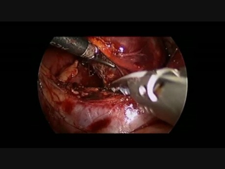 Right Laparoscopic Adrenalectomy in 9 month old infant