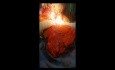  Huge Uterine Leiomyosarcoma With a Loud Pop Sound Upon Disimpaction From The Pelvis 