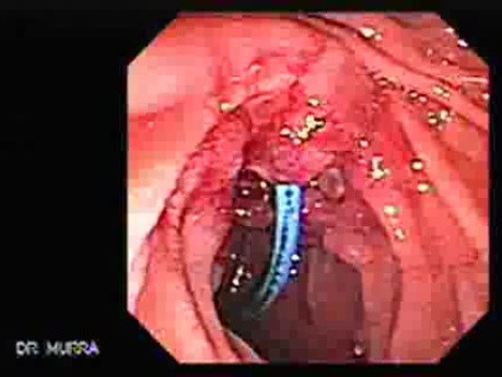 Adenocarcinoma of the Vater Papilla - Stent Migration (7 of 7)