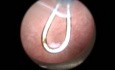 Microhysteroscopy - Tips & Tricks in Stenosis of External Exit of Cervical Canal